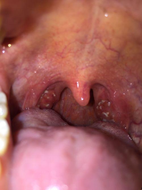 吃瓜容易喉咙烧,喉咙烧痛的警示与应对攻略